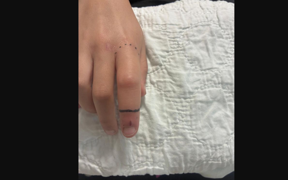 Bimba morsa da vipera